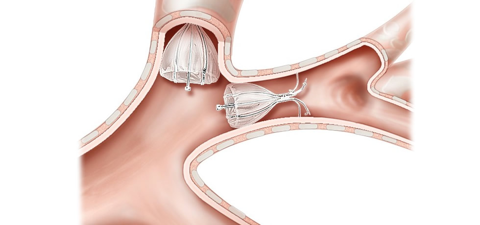 Внутрибронхиальные клапанные системы  | Intrabronchial valve systems