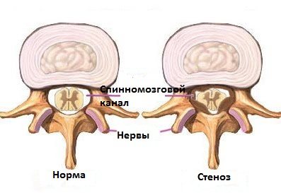 Отделенные результаты лечения стеноза позвоночного канала